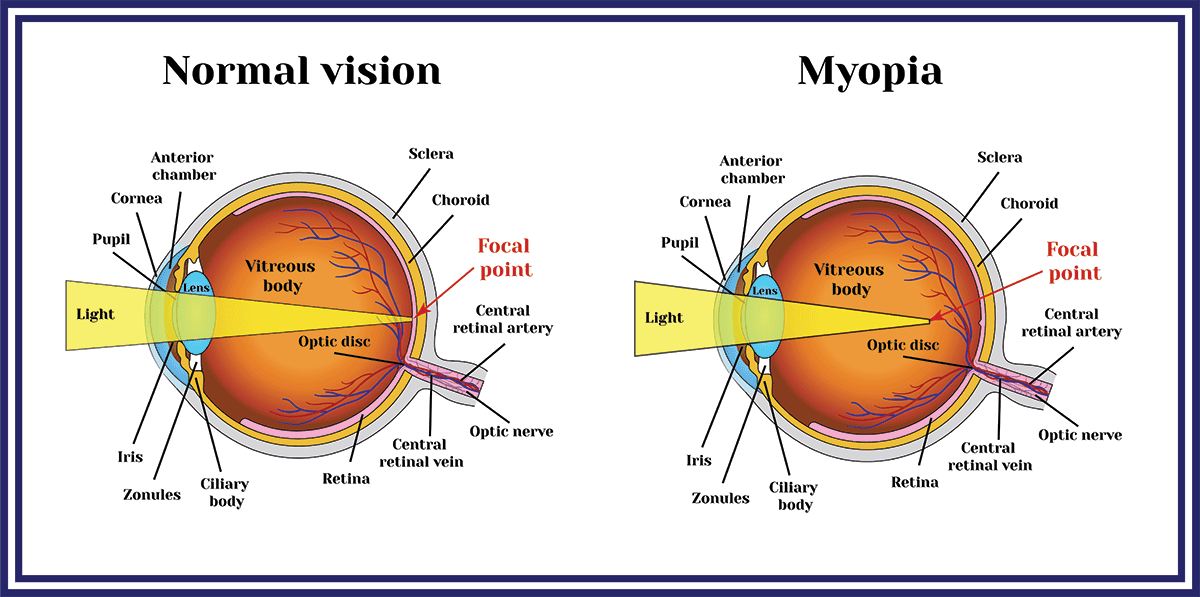 EVO implantable contact lens LA