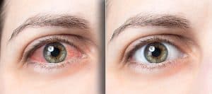 Dry eye disease treatment Los Angeles