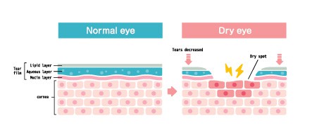 dry eye disease treatment 2023 Los Angeles