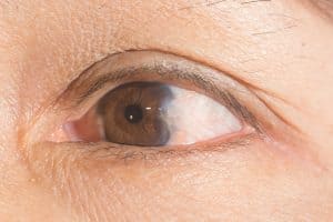 Pterygium & Pinguecula Treatment