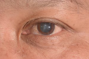 Cataract Surgery