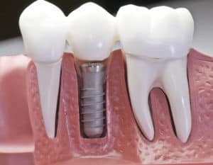 Dental Implant Recovery and Results in Urbandale, IA