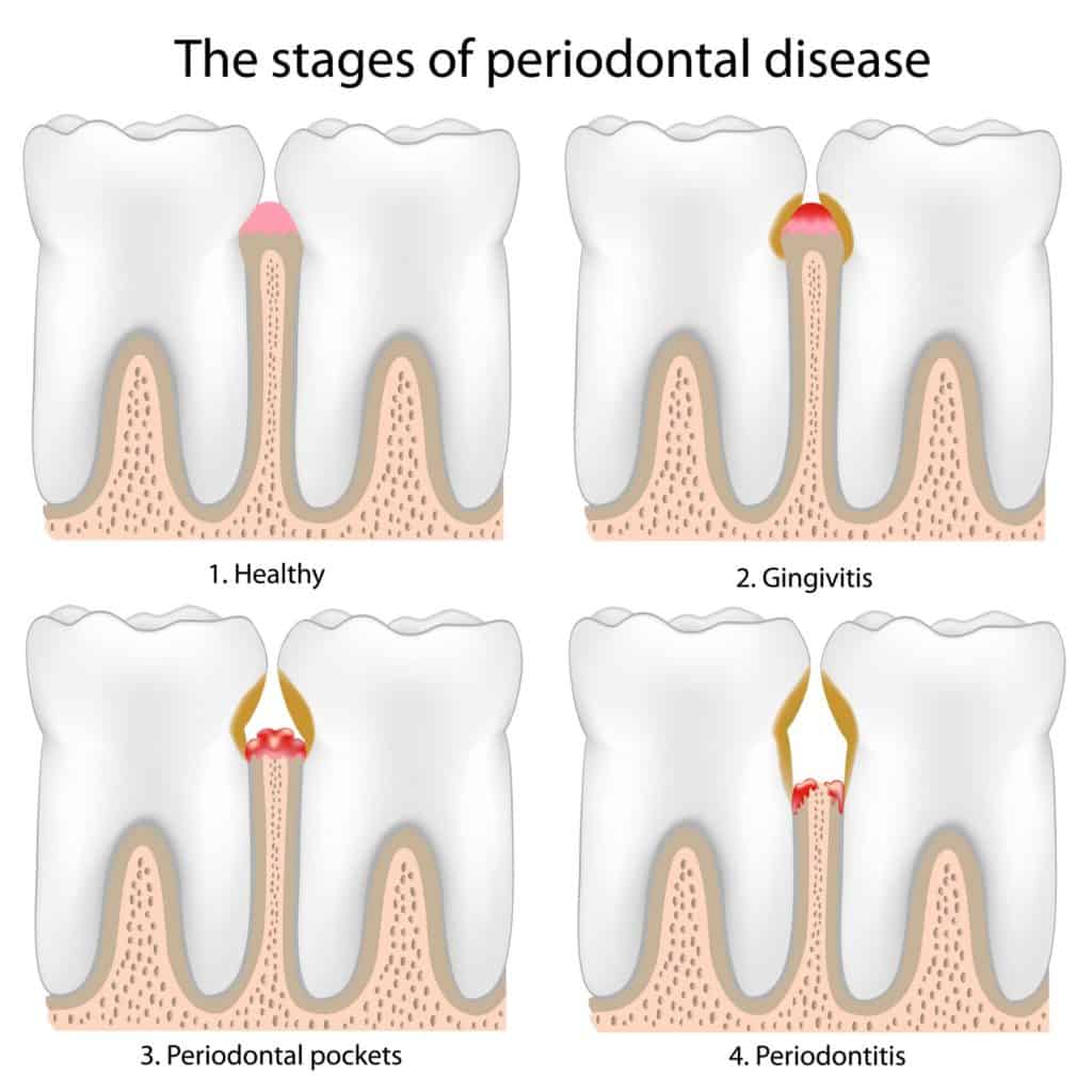 Periodontal Treatment Des Moines Gum Disease Treatment Urbandale