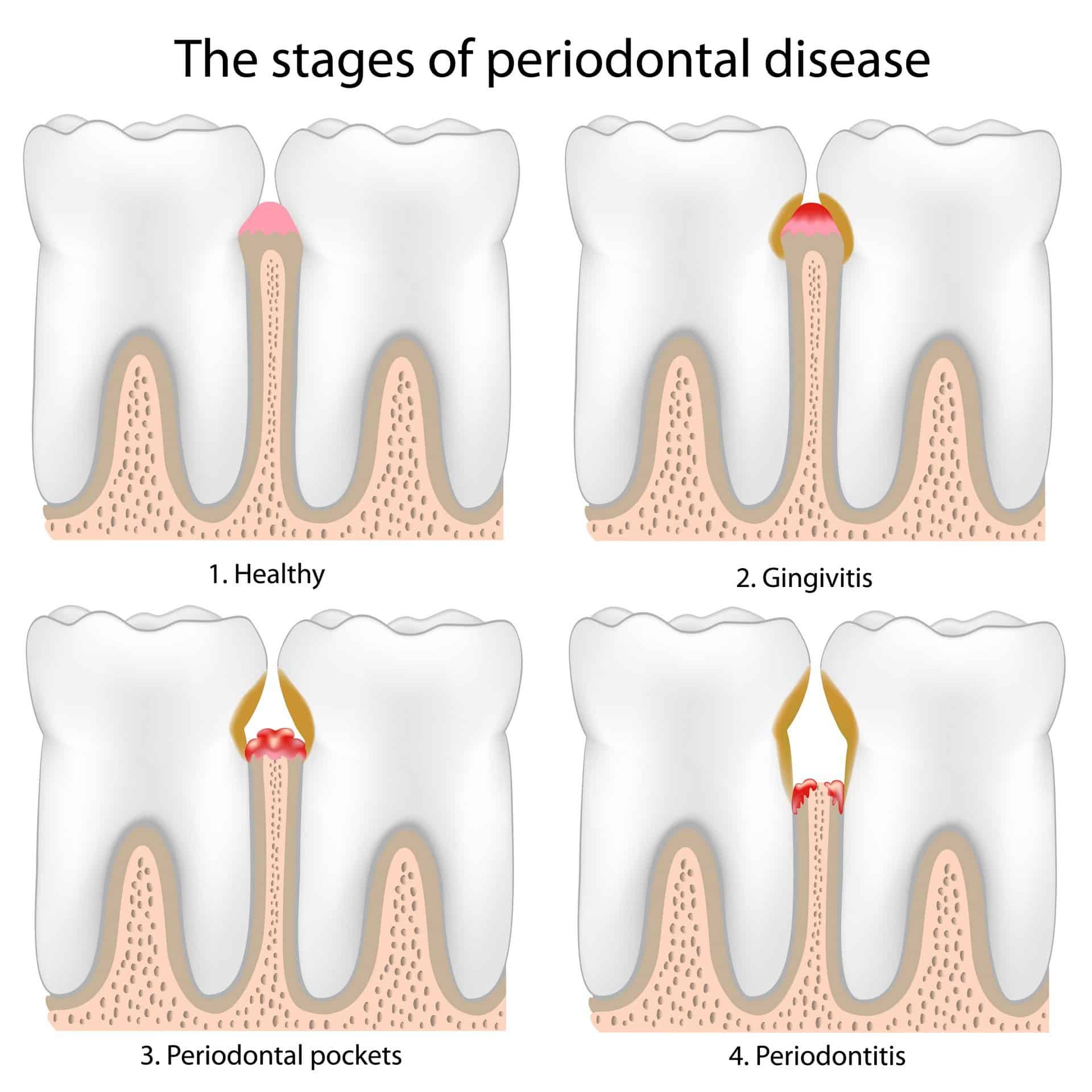 Gum Infection Treatment