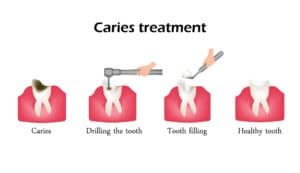 Caries Treatment in Urbandale, IA