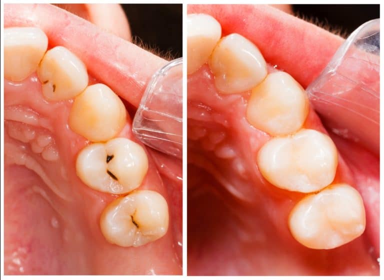 Dental Filling Before After Photos in Des Moines, IA