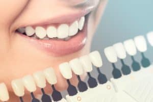 Dental Veneers in Urbandale, IA