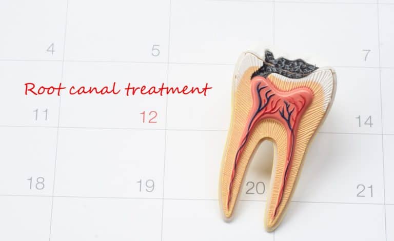 Root Canal in Des Moines, IA