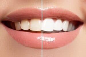 Teeth Whitening Urbandale IA