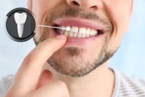 Dental Implants in Des Moines