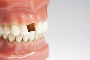 Teeth Replacement in Urbandale, IA