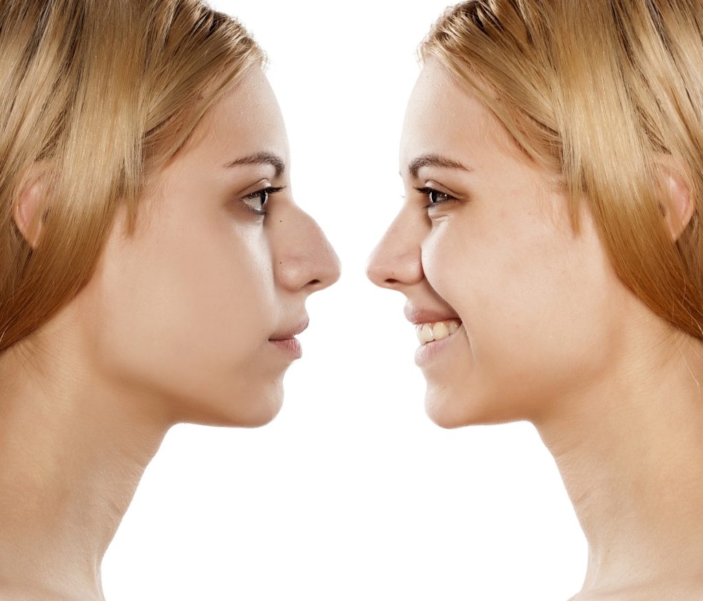 signs-of-a-good-rhinoplasty-procedure-portland-or-nose-surgery