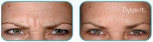 Dysport Effect on Frown Lines and Eyebrows