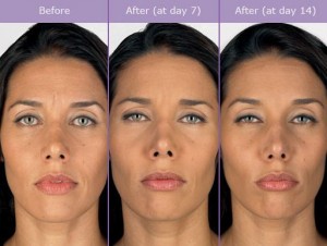 Botox Effects on Patient