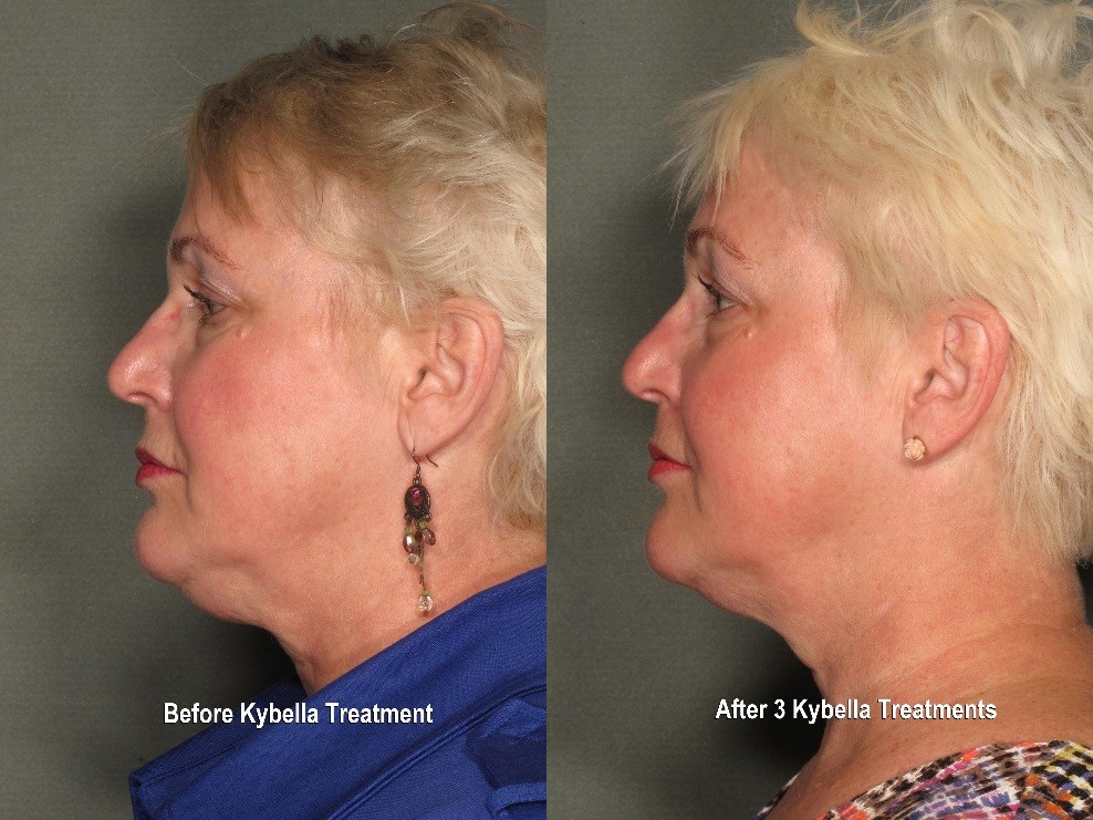 Kybella Double Chin Reduction Results
