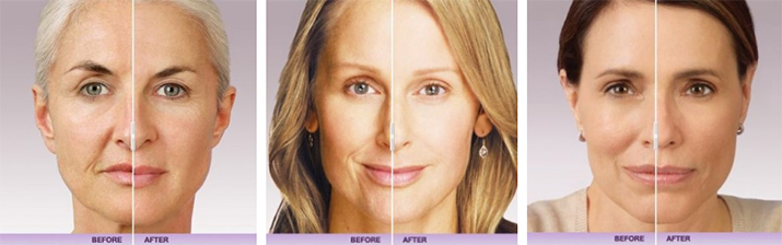 Before & After Juvederm filler in Portland