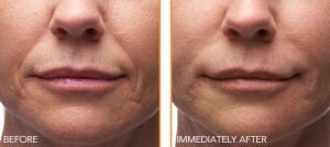 Portland facial injectables patient