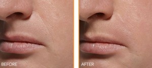 Patient before and after dermal fillers in Portland