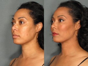 Before-After-Radiesse-Cheek-Augmentation