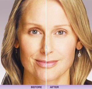 Juvederm-Capture