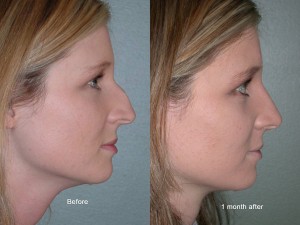 best rhinoplasty surgeon Portland