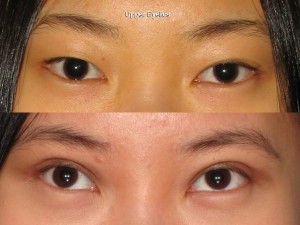 Portland Blepharoplasty surgeon