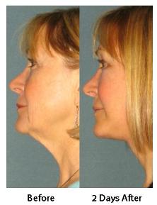 Before & After Rapid Recovery Face Lift Portland