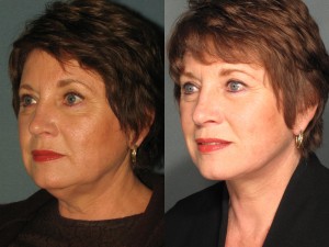 Before & After Browlift
