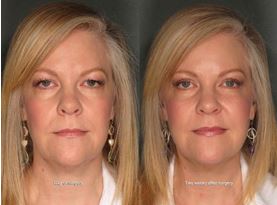 Before and After Blepharoplasty in Portland 