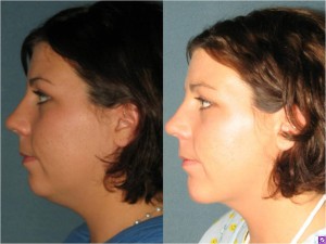 Before & After Chin Augmentation