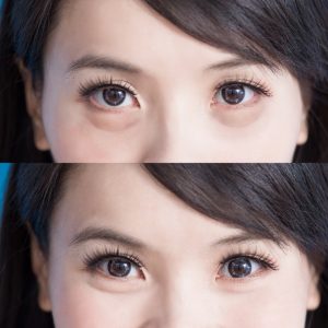 Before/ After Asian Eyelid Surgery Results