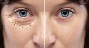 Patient Before and After Photos of Lower Eyelid Surgery