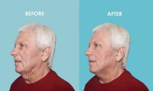 Male Facelift before and after in Portland, OR