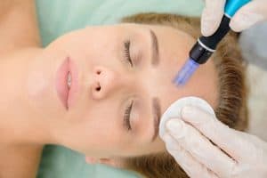 Microneedling Cleveland OH