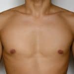 Male Breast Reduction in Westlake