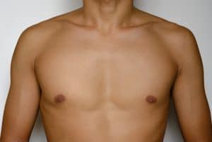 Male Breast Reduction in Westlake