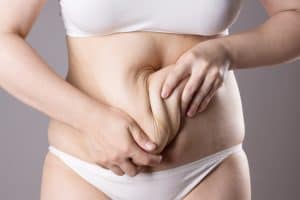 Woman twists her loose belly skin following major weight loss as she prepares for a tummy tuck