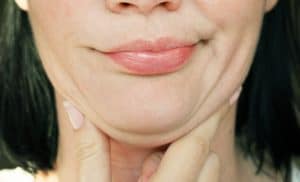 Woman grimaces as she squeezes loose fat and skin under her chin and considers neck lipo