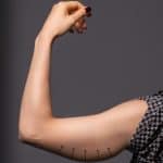 Woman holds her arm up, reveals loose hanging skin after weight loss, before her arm lift