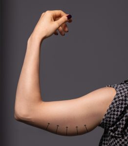 Woman holds her arm up, reveals loose hanging skin after weight loss, before her arm lift