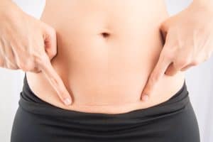 Close-up of a woman's stomach with a pospartum C-section scar, in need of treatment.