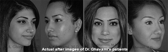 Before & after Beverly Hills rhinoplasty patients 