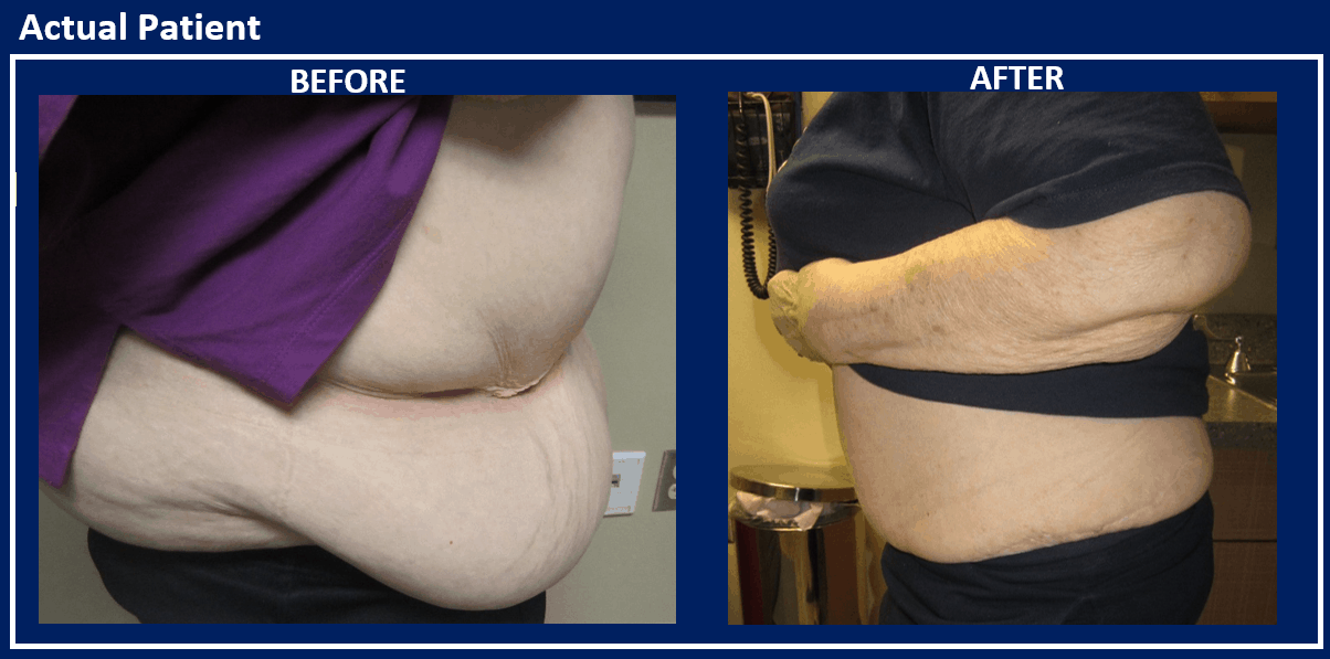 Tummy Tuck vs Panniculectomy