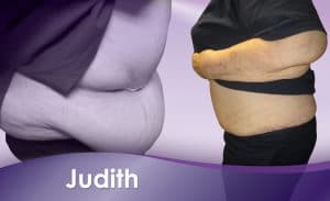 Before and After Weight Loss Judith