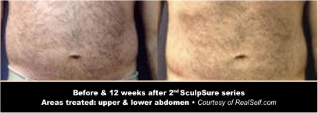 SculpSure Before and After