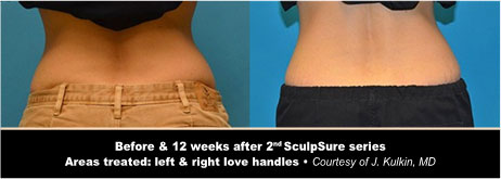 SculpSure Before and After