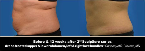 SculpSure Before and After