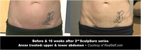 SculpSure Before and After