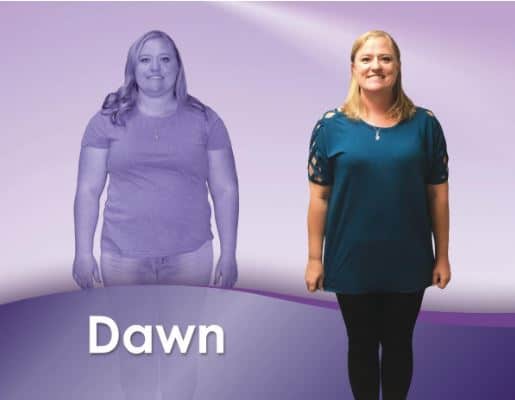 10 Years After Gastric Sleeve: Long-Term Success