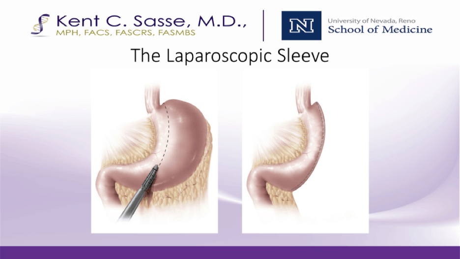 sasse-surgical-reno-metabolic-surgery-laparoscopic-sleeve